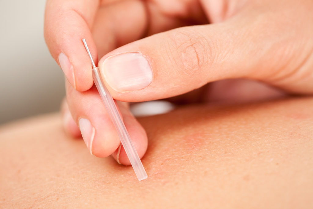 Woman using a plastic guide and acupuncture needle